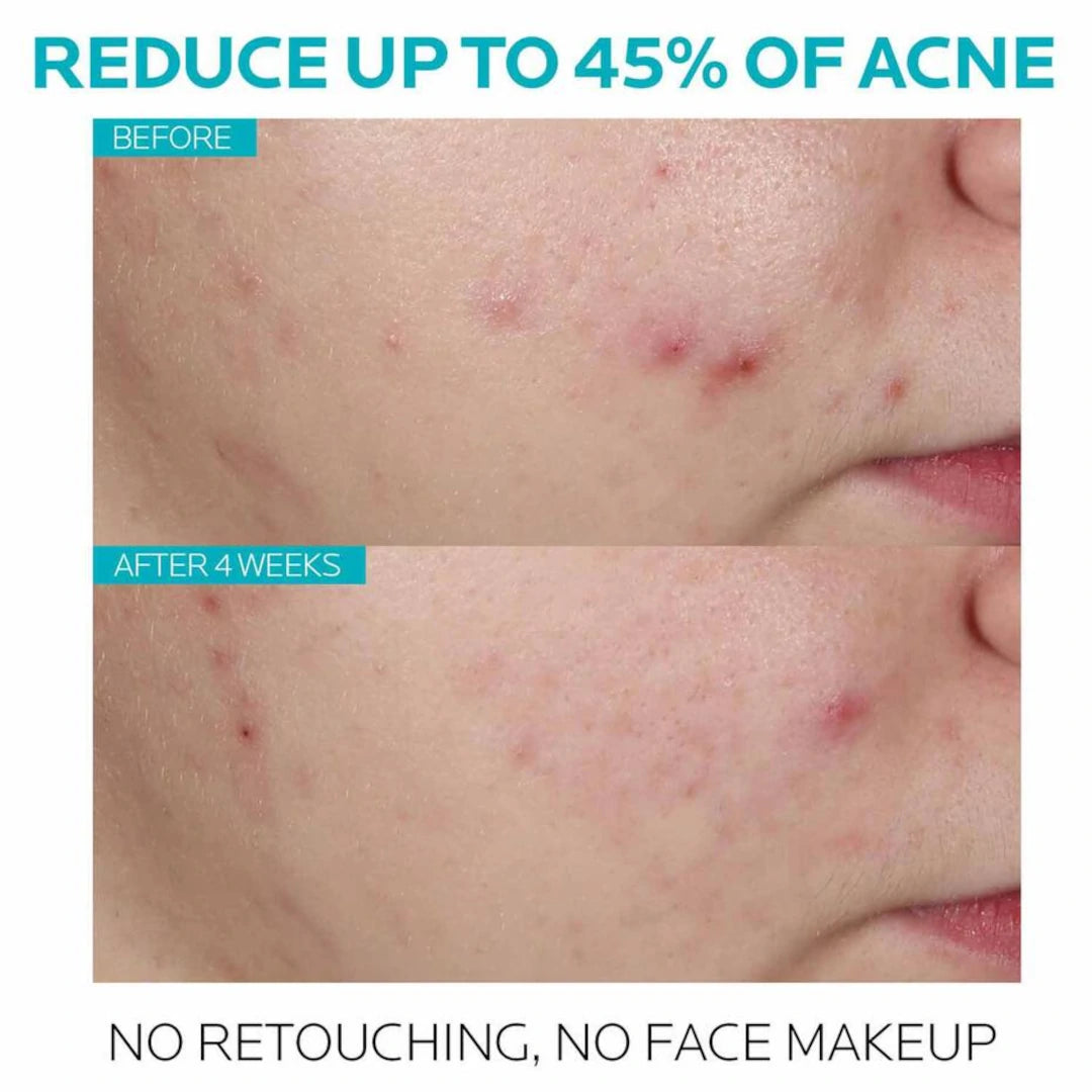 EFFACLAR ADAPALENE GEL 0.1% TOPICAL RETINOID FOR ACNE