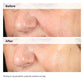 Alpha Arbutin 2% + Hyaluronic Acid for Hyperpigmentation