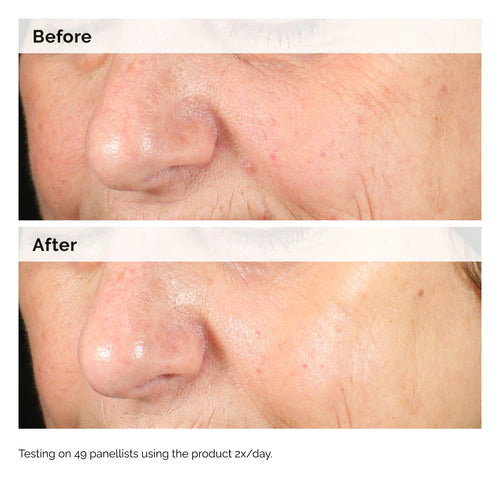 Alpha Arbutin 2% + Hyaluronic Acid for Hyperpigmentation